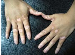 手部白癜风难以治疗的原因有哪些