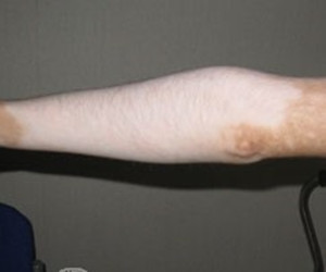 手臂上的白斑是什么因素引起的呢