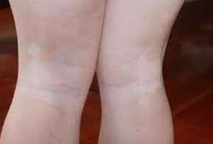腿部白癜风的症状表现有哪些