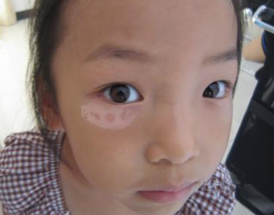 孩子脸上的白斑是不是白癜风